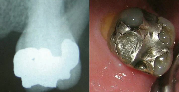 Clinical and radiographic example of an amalgam restoration, 2007; illustrative archive.